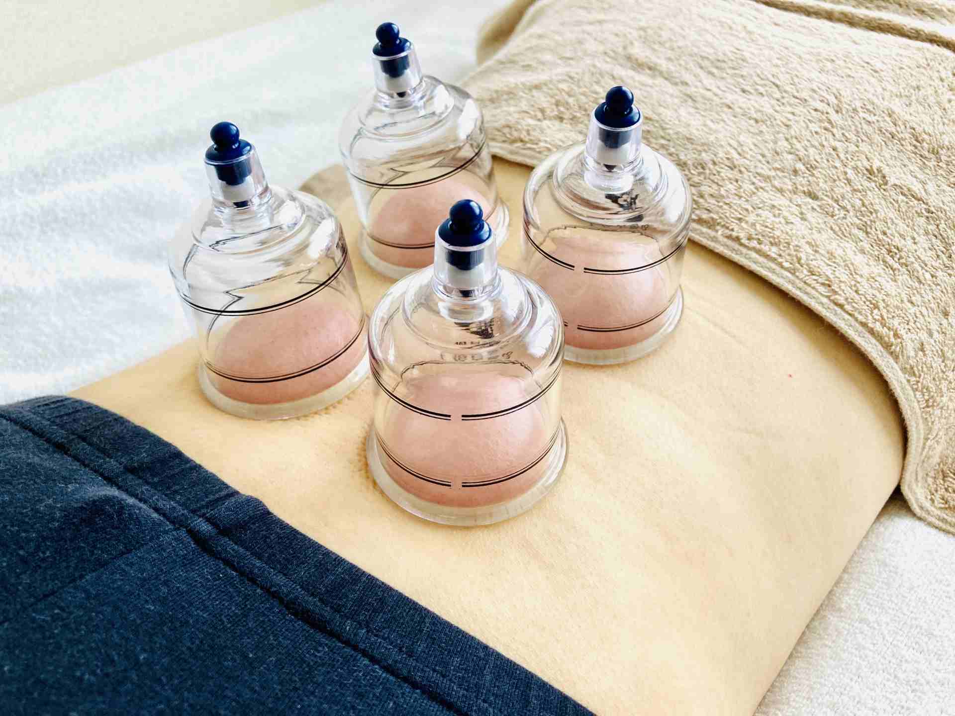 カッピング治療【上半身or下半身】